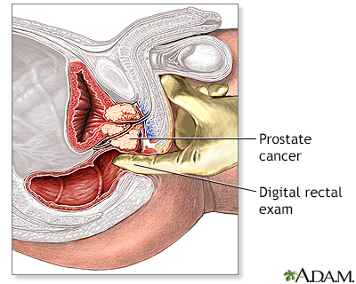 Prostate cancer