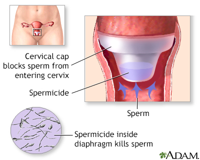 Cervical cap