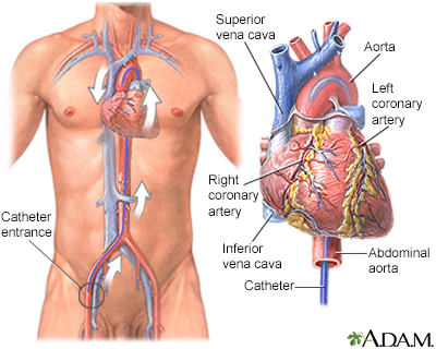 Cardiac catheterization