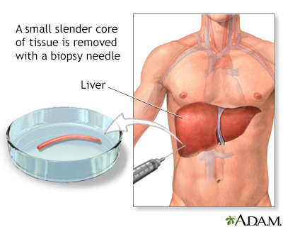 Liver biopsy