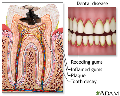 Gingivitis