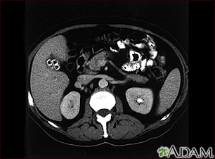 Cholecystolithiasis