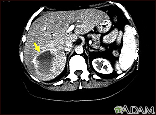 Hemangioma - CT scan