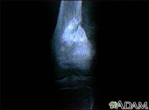 Osteogenic sarcoma - X-ray