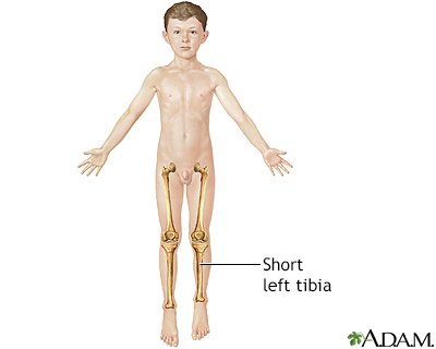 Leg lengthening - series