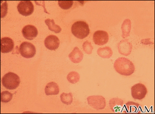 Thalassemia major