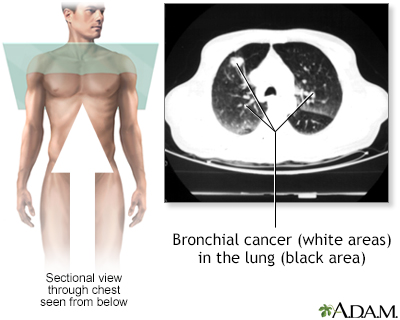 Bronchial cancer - CT scan