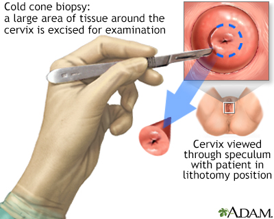 Cold cone biopsy