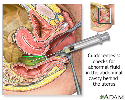 Culdocentesis