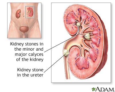 Nephrolithiasis