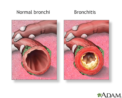 Bronchitis