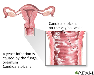 Yeast infections