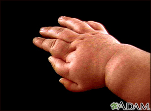 Polydactyly - an infant's hand