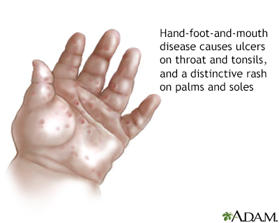 Hand-foot-and-mouth disease