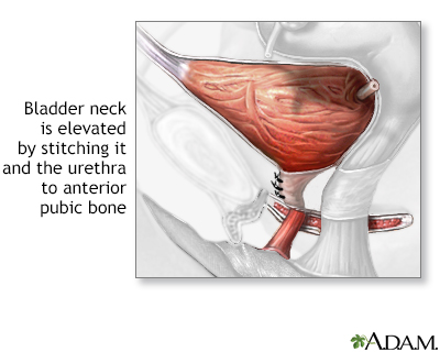 Stress incontinence