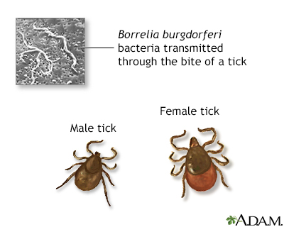 Tertiary Lyme disease