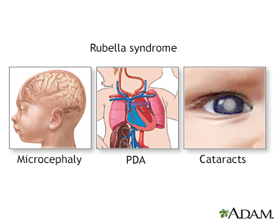 Rubella Syndrome