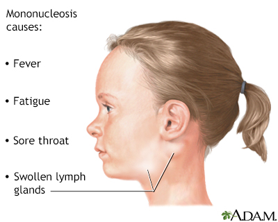 Infectious mononucleosis