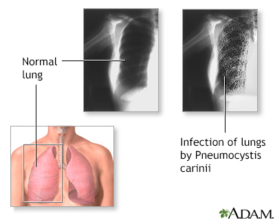 Pneumocystosis