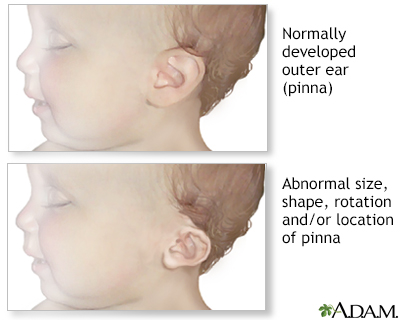 Ear abnormalities