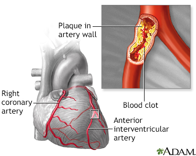 Atherosclerosis