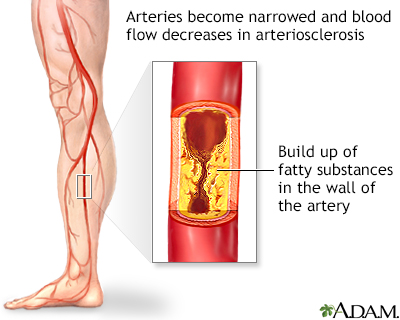 Arteriosclerosis of the extremities