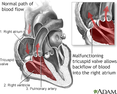 Tricuspid Regurgitation