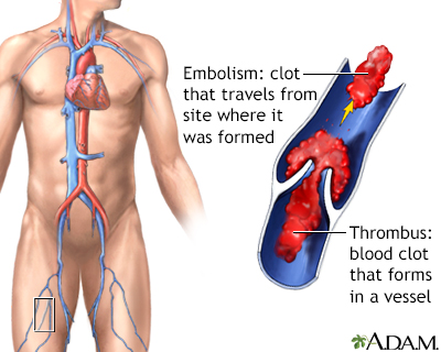 Thrombus