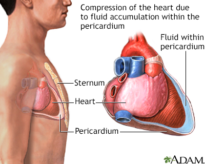 Cardiac tamponade