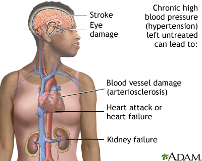 Untreated hypertension