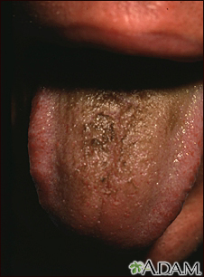 Black hairy tongue