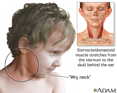 Torticollis (wry neck)