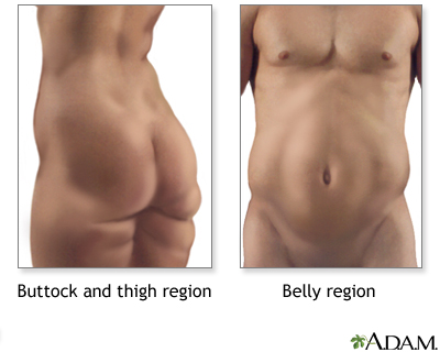 Liposuction - series - Indications