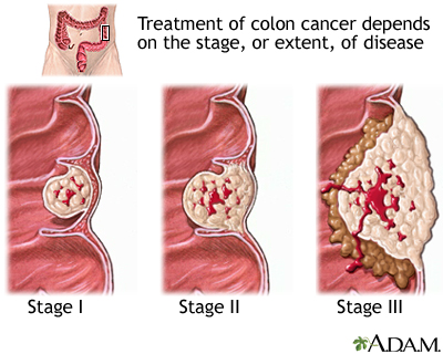 Stages of cancer