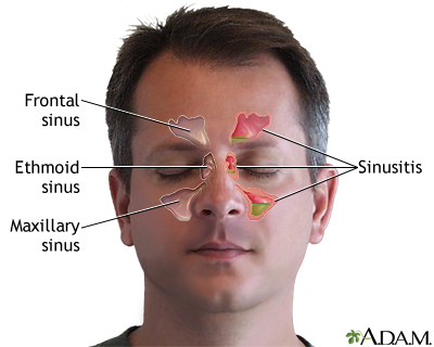 Sinusitis