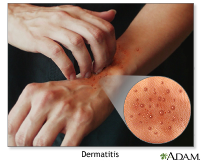 Atopic dermatitis