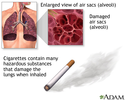 Smoking and COPD (chronic obstructive pulmonary disorder)