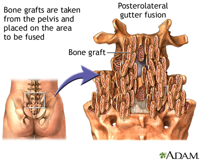 Procedure - Posterolateral gutter fusion