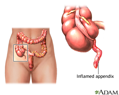 Appendicitis