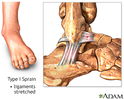 Type I ankle sprain