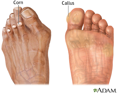 Corns and calluses