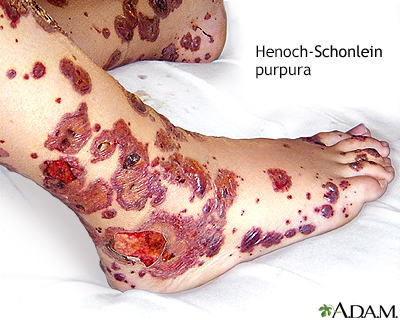 Henoch-Schonlein purpura