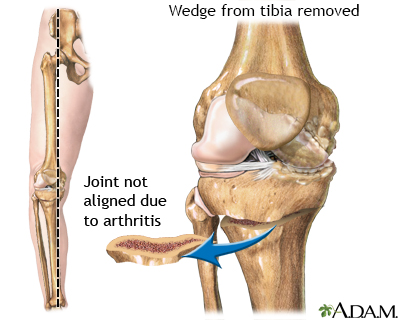 Tibial osteotomy