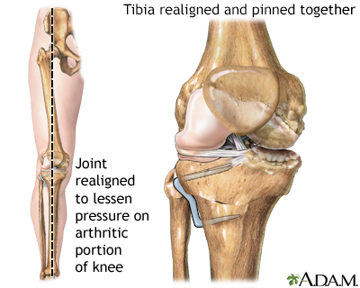 Knee after tibial osteotomy