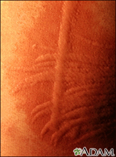 Dermatographism - close-up