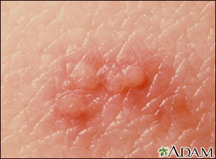 Herpes zoster (shingles) - close-up of lesion