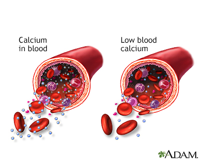 Hypocalcemia