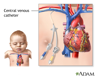 Central venous catheter