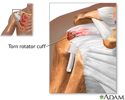 Torn rotator cuff