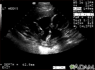 Ultrasound, normal fetus - arm and legs